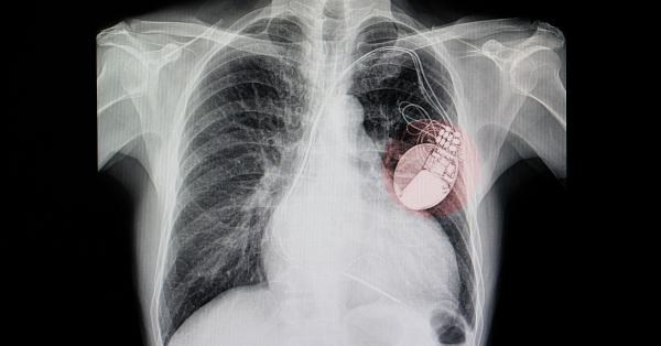 x-ray image of a pacemaker installed in a body